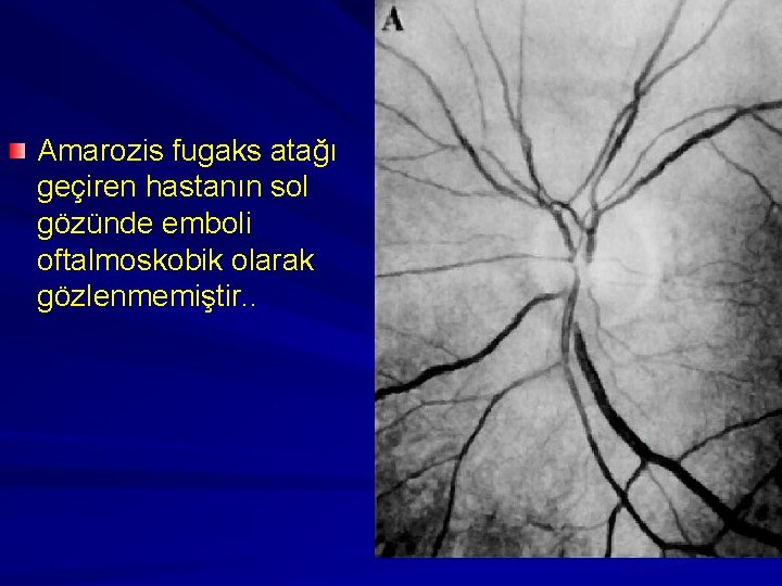 Amarozis fugaks atağı geçiren hastanın sol gözünde emboli oftalmoskobik olarak gözlenmemiştir. . 