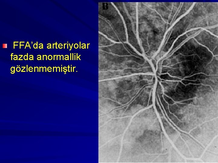 FFA’da arteriyolar fazda anormallik gözlenmemiştir. 