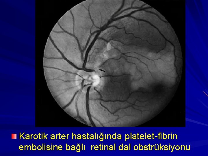 Karotik arter hastalığında platelet-fibrin embolisine bağlı retinal dal obstrüksiyonu 