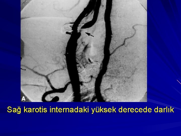 Sağ karotis internadaki yüksek derecede darlık 