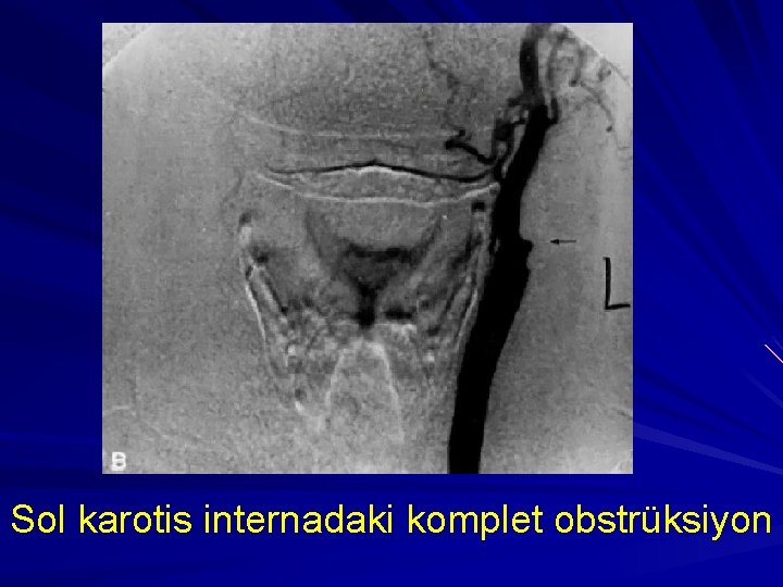 Sol karotis internadaki komplet obstrüksiyon 