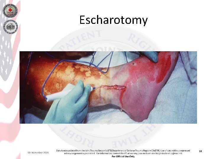 Escharotomy 05 November 2020 18 