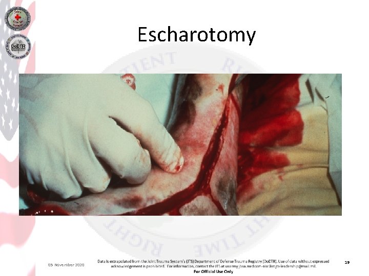 Escharotomy 05 November 2020 19 