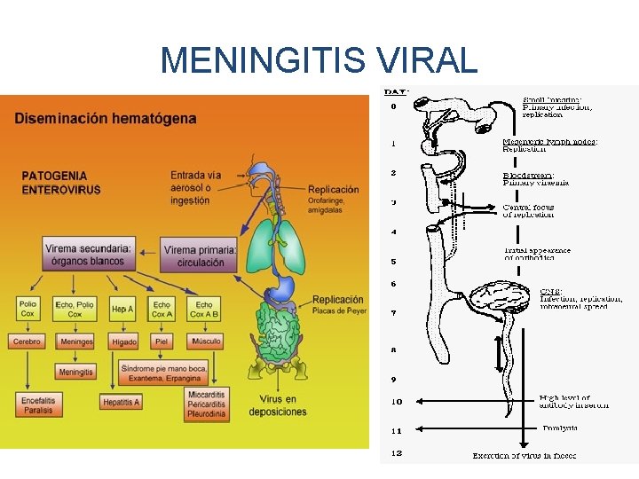 MENINGITIS VIRAL 