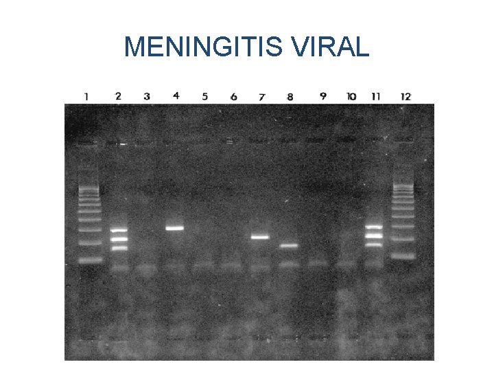 MENINGITIS VIRAL 