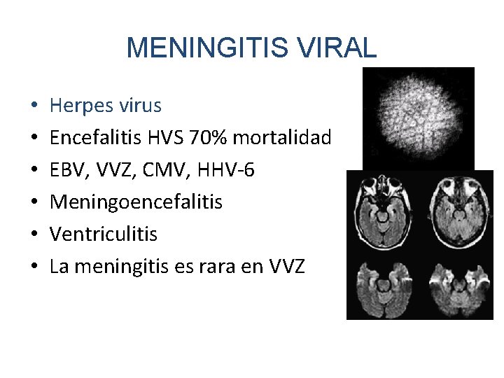 MENINGITIS VIRAL • • • Herpes virus Encefalitis HVS 70% mortalidad EBV, VVZ, CMV,