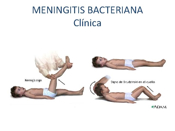 MENINGITIS BACTERIANA Clínica 