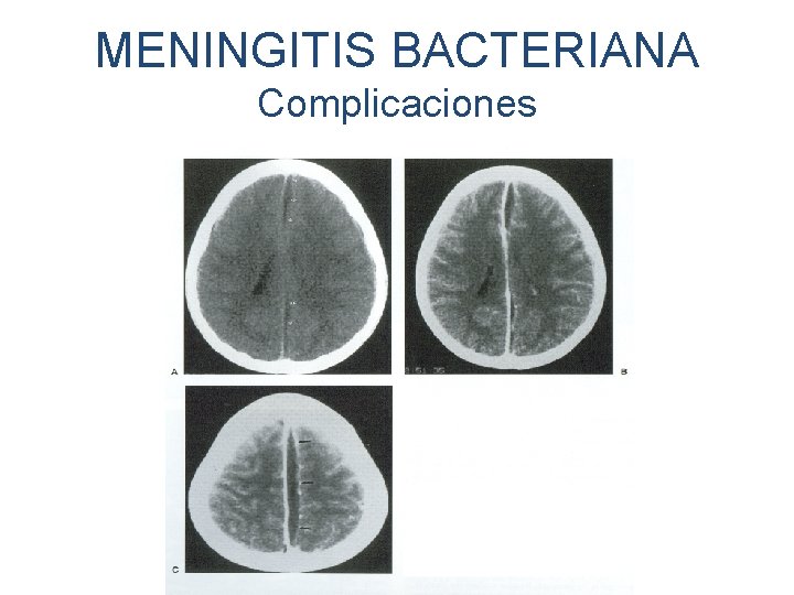 MENINGITIS BACTERIANA Complicaciones 