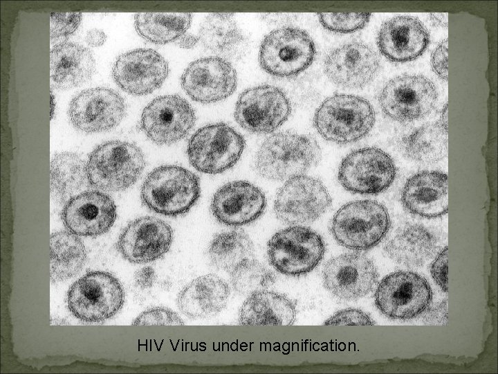 HIV Virus under magnification. 