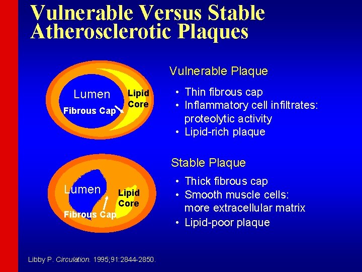 Vulnerable Versus Stable Atherosclerotic Plaques Vulnerable Plaque Lumen Fibrous Cap Lipid Core • Thin