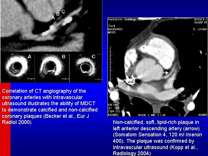 Correlation of CT angiography of the coronary arteries with intravascular ultrasound illustrates the ability