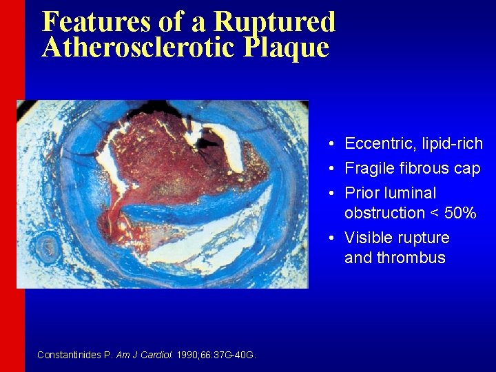 Features of a Ruptured Atherosclerotic Plaque • Eccentric, lipid-rich • Fragile fibrous cap •
