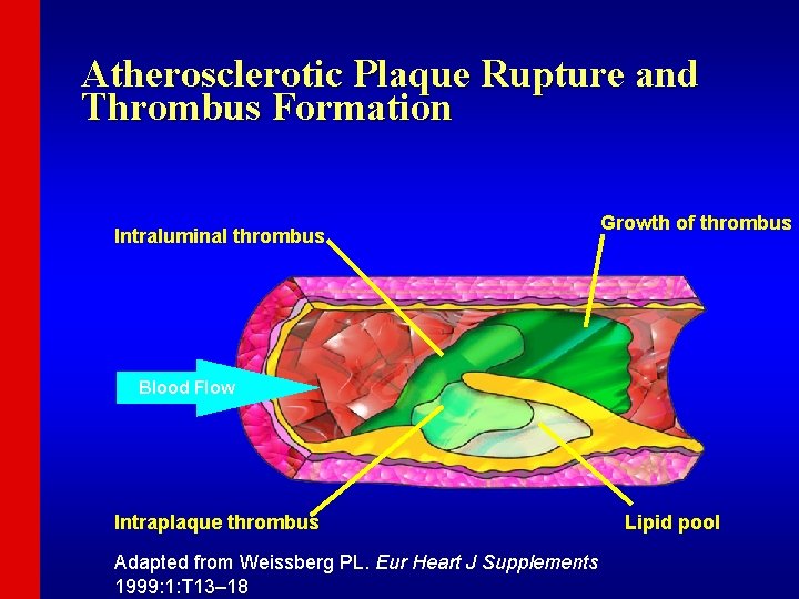 Atherosclerotic Plaque Rupture and Thrombus Formation Intraluminal thrombus Growth of thrombus Blood Flow Intraplaque