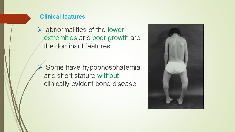 Clinical features Ø abnormalities of the lower extremities and poor growth are the dominant