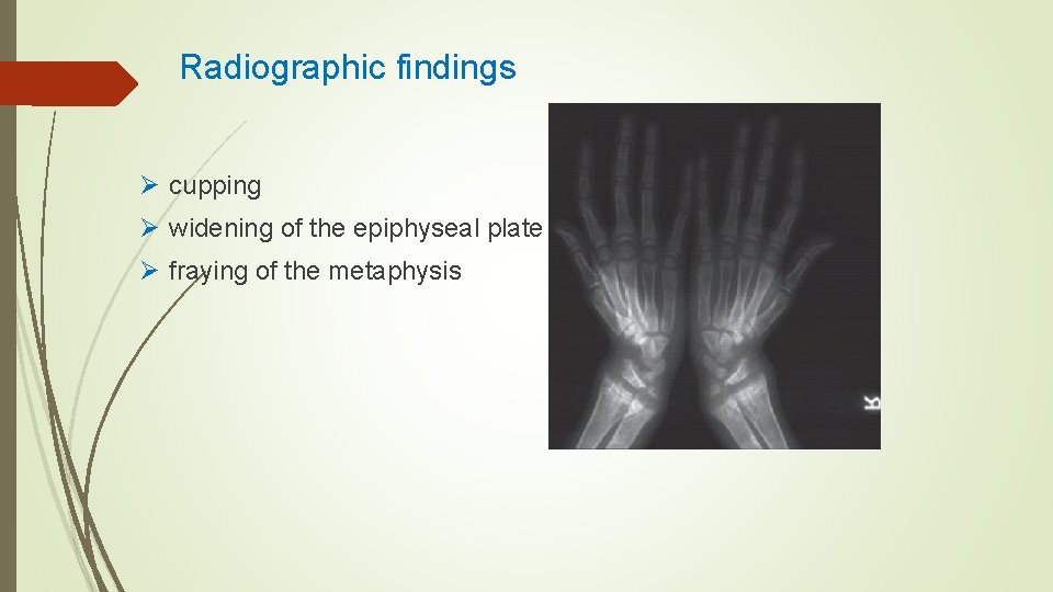 Radiographic findings Ø cupping Ø widening of the epiphyseal plate Ø fraying of the