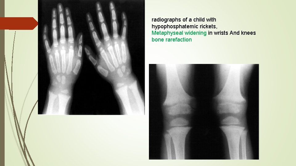 radiographs of a child with hypophosphatemic rickets, Metaphyseal widening in wrists And knees bone