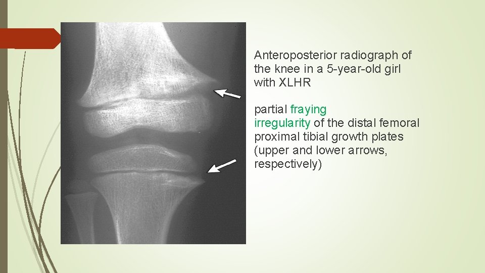 Anteroposterior radiograph of the knee in a 5 -year-old girl with XLHR partial fraying