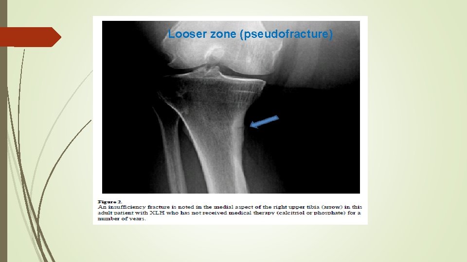 Looser zone (pseudofracture) 