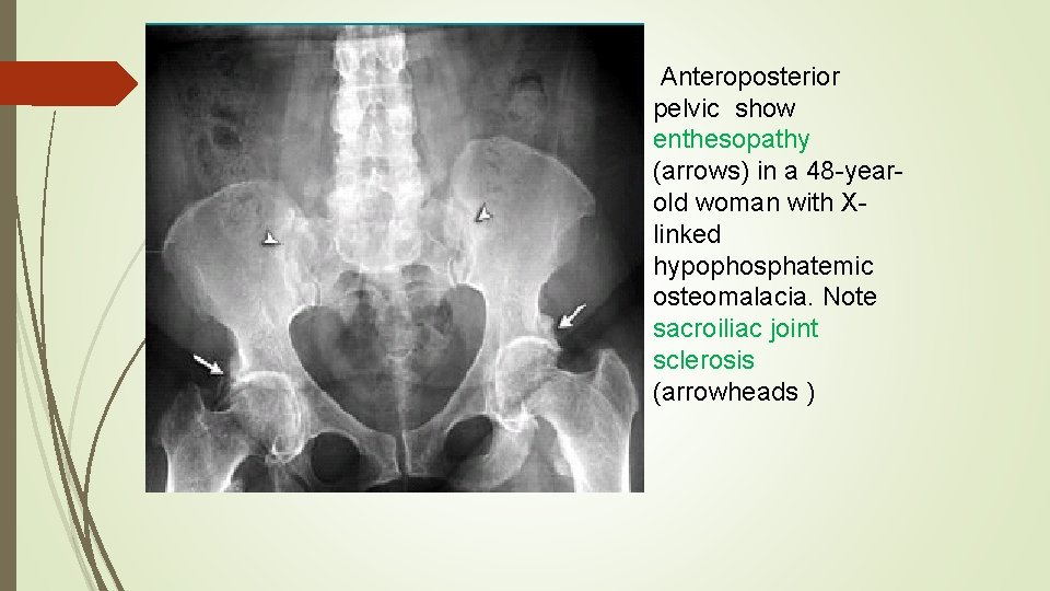  Anteroposterior pelvic show enthesopathy (arrows) in a 48 -yearold woman with Xlinked hypophosphatemic