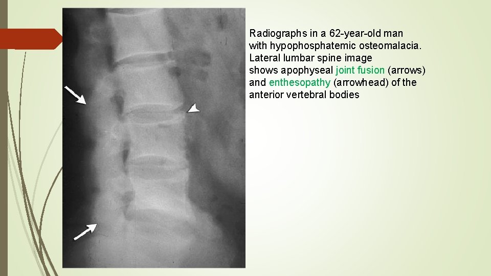 Radiographs in a 62 -year-old man with hypophosphatemic osteomalacia. Lateral lumbar spine image shows