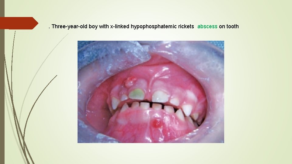 . Three-year-old boy with x-linked hypophosphatemic rickets abscess on tooth 