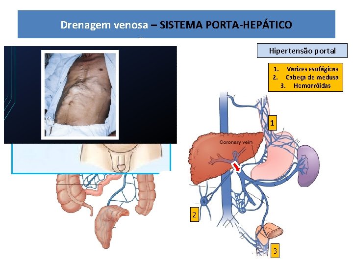 Drenagem venosa – SISTEMA PORTA-HEPÁTICO Hipertensão portal 1. Varizes esofágicas 2. Cabeça de medusa