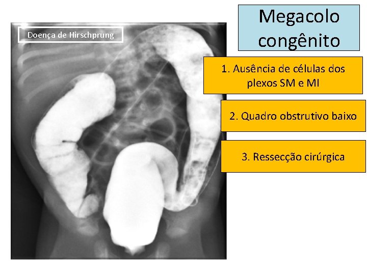 Doença de Hirschprung Megacolo congênito 1. Ausência de células dos plexos SM e MI