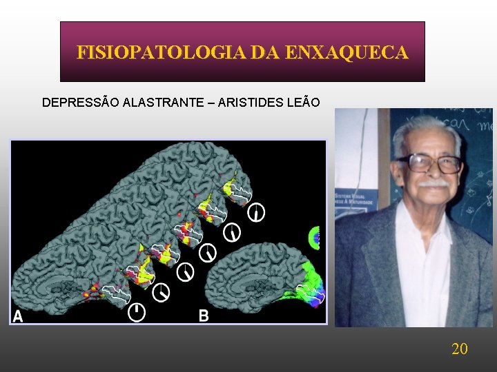 FISIOPATOLOGIA DA ENXAQUECA DEPRESSÃO ALASTRANTE – ARISTIDES LEÃO 20 