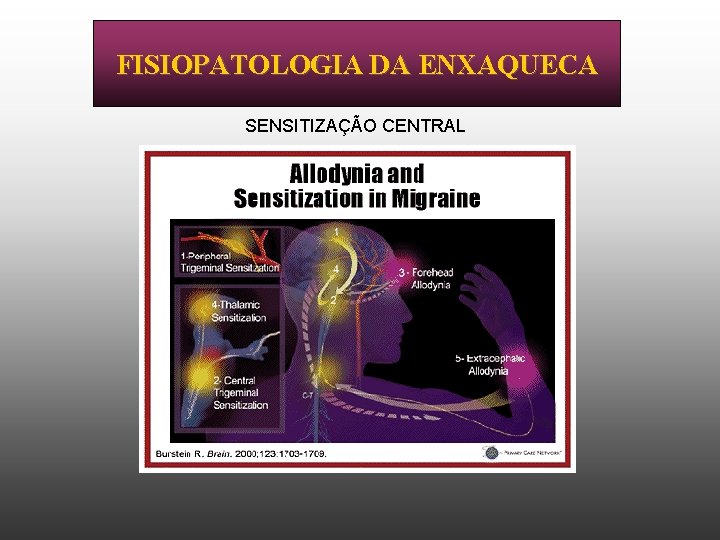 FISIOPATOLOGIA DA ENXAQUECA SENSITIZAÇÃO CENTRAL 