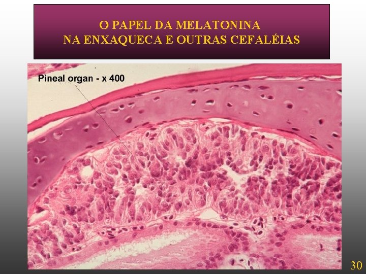 O PAPEL DA MELATONINA PINEAL - EHISTOLOGIA NA ENXAQUECA OUTRAS CEFALÉIAS 30 