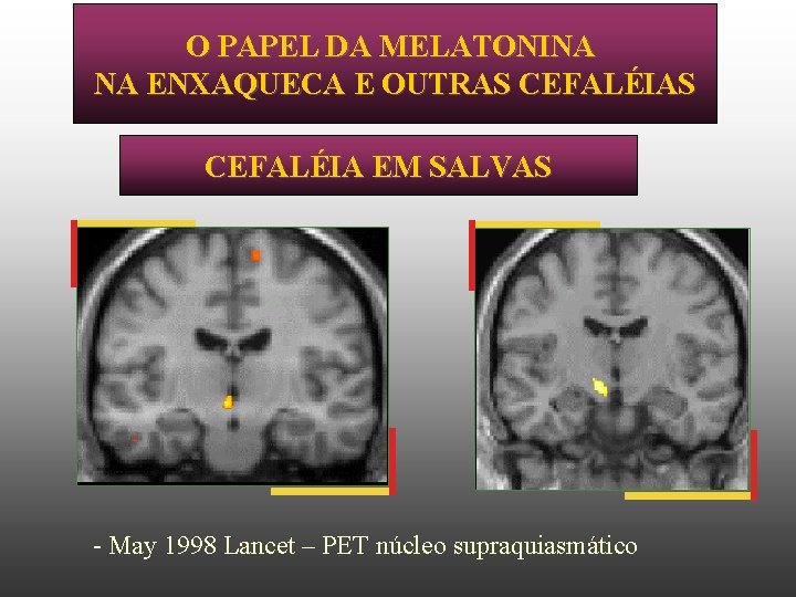 O PAPEL DA MELATONINA NA ENXAQUECA E OUTRAS CEFALÉIA EM SALVAS - May 1998