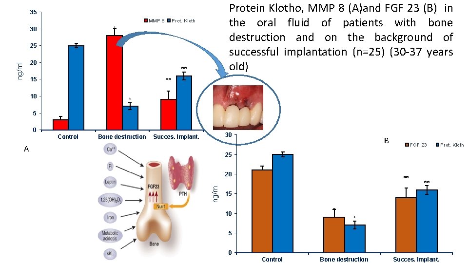 Protein Klotho, MMP 8 (A)and FGF 23 (B) in the oral fluid of patients