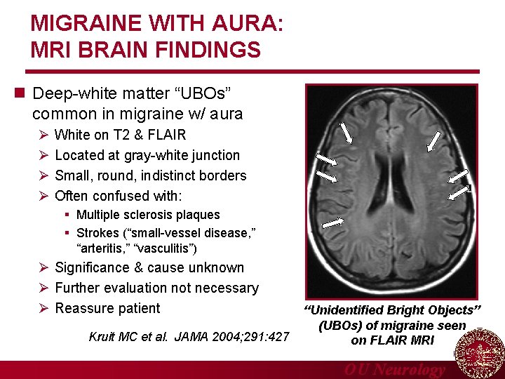 MIGRAINE WITH AURA: MRI BRAIN FINDINGS n Deep-white matter “UBOs” common in migraine w/