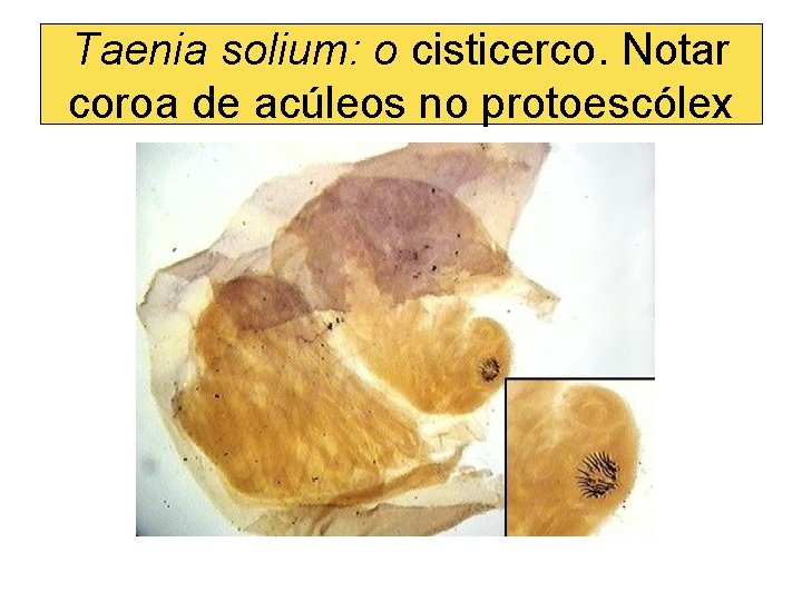 Taenia solium: o cisticerco. Notar coroa de acúleos no protoescólex 