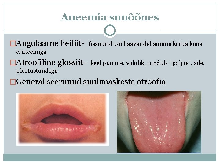 Aneemia suuõõnes �Angulaarne heiliit- fissuurid või haavandid suunurkades koos erüteemiga �Atroofiline glossiit- keel punane,