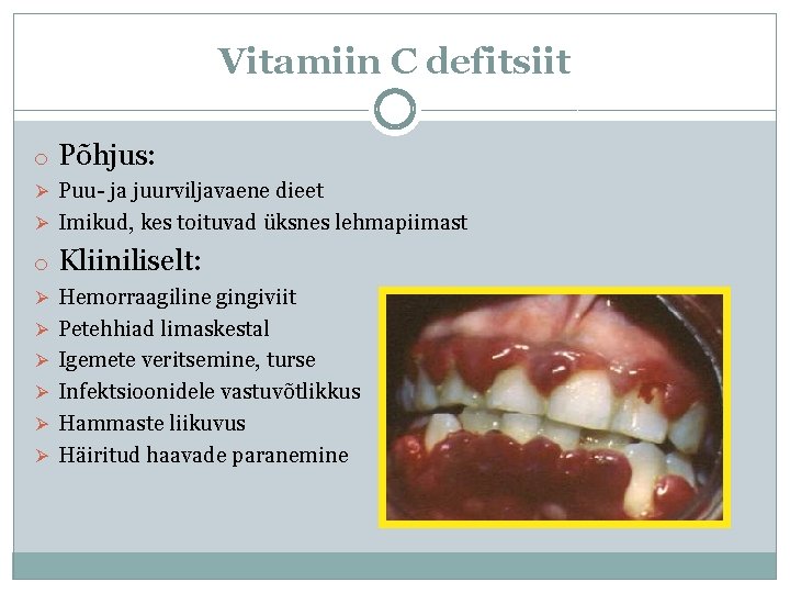 Vitamiin C defitsiit o Põhjus: Ø Puu- ja juurviljavaene dieet Ø Imikud, kes toituvad