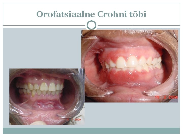 Orofatsiaalne Crohni tõbi 