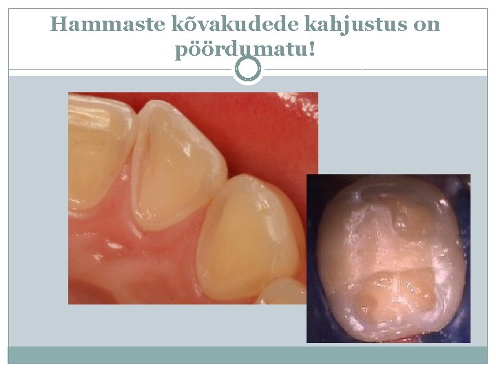 Hammaste kõvakudede kahjustus on pöördumatu! 