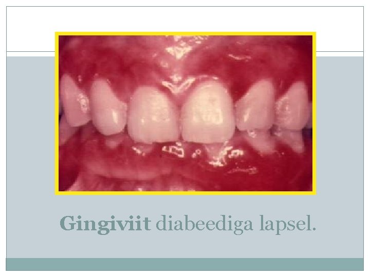 Gingiviit diabeediga lapsel. 