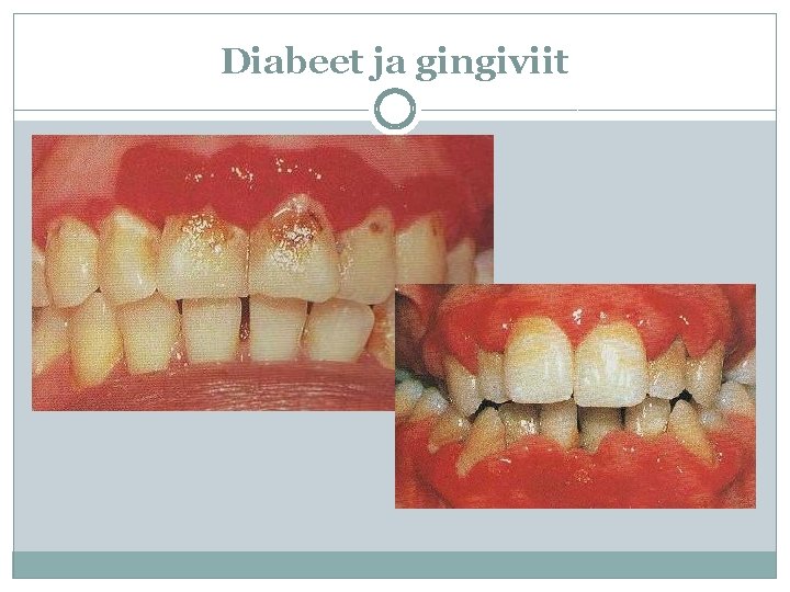 Diabeet ja gingiviit 