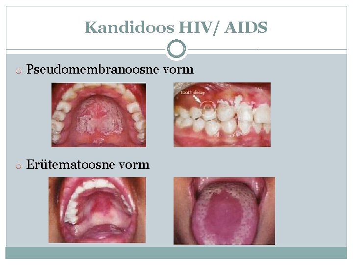 Kandidoos HIV/ AIDS o Pseudomembranoosne vorm o Erütematoosne vorm 