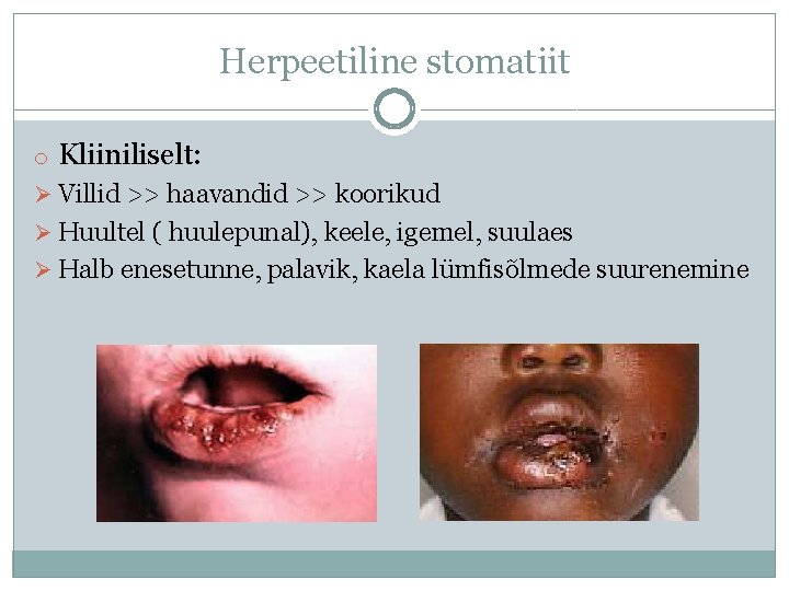 Herpeetiline stomatiit o Kliiniliselt: Ø Villid >> haavandid >> koorikud Ø Huultel ( huulepunal),