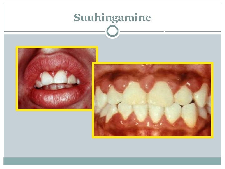 Suuhingamine 