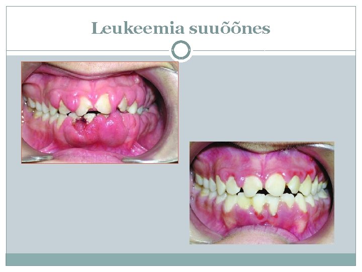 Leukeemia suuõõnes 