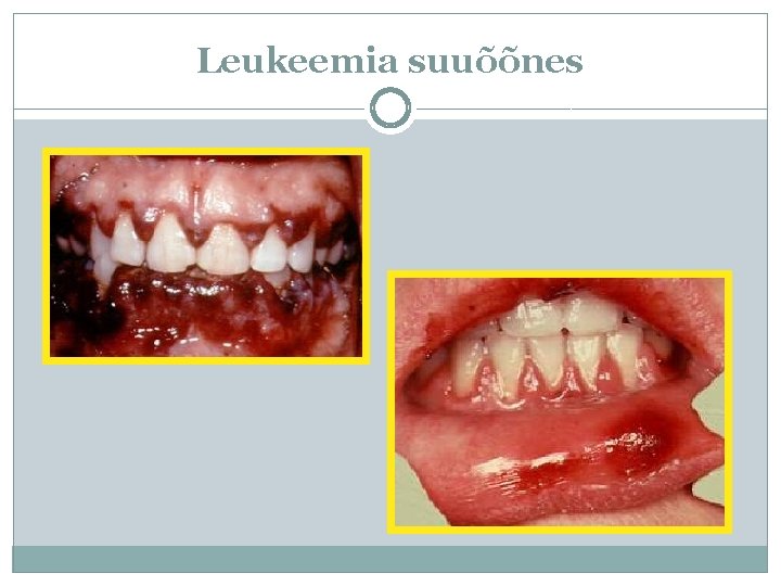 Leukeemia suuõõnes 