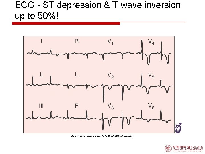 ECG - ST depression & T wave inversion up to 50%! 