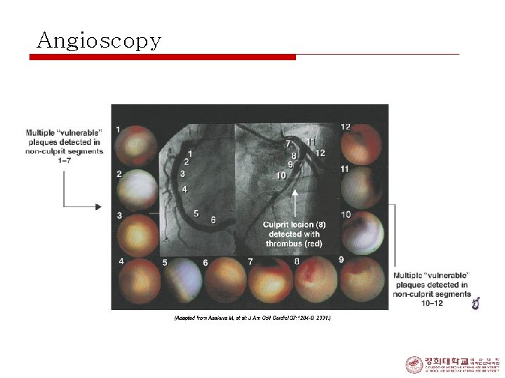 Angioscopy 