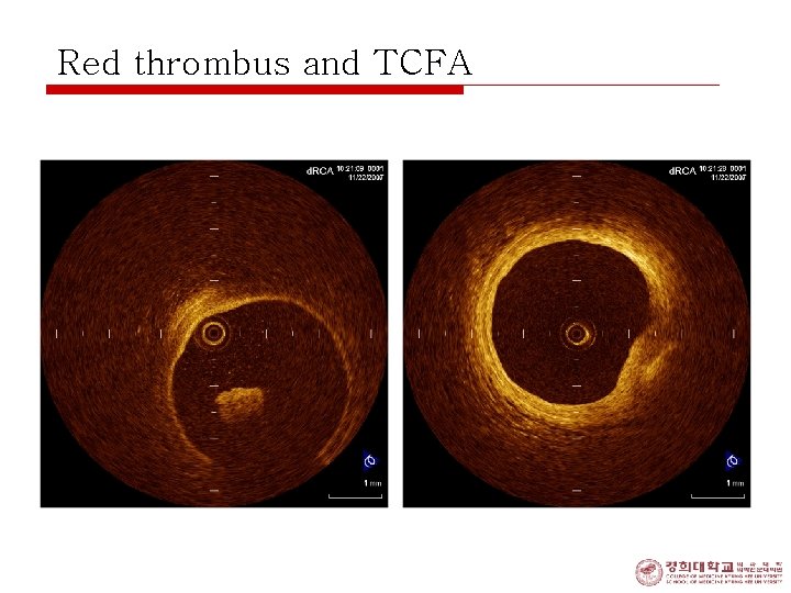 Red thrombus and TCFA 