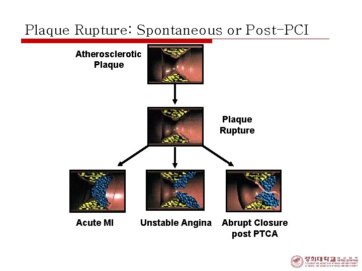 Plaque Rupture: Spontaneous or Post-PCI Atherosclerotic Plaque Rupture Acute MI Unstable Angina Abrupt Closure