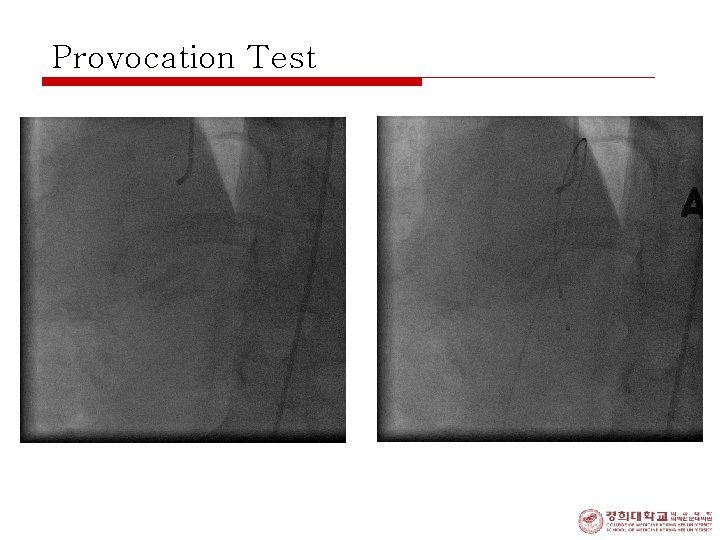 Provocation Test 